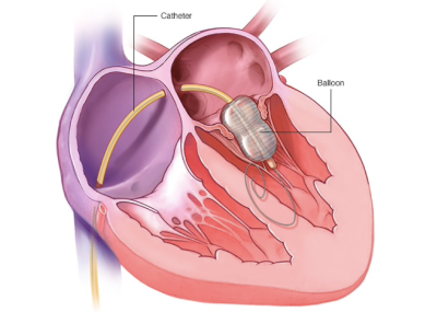 Balloon Mitral Aortic by Dr. Nagesh Waghmare, Interventional Cardiologist & Heart Specialist in Mumbai, India.