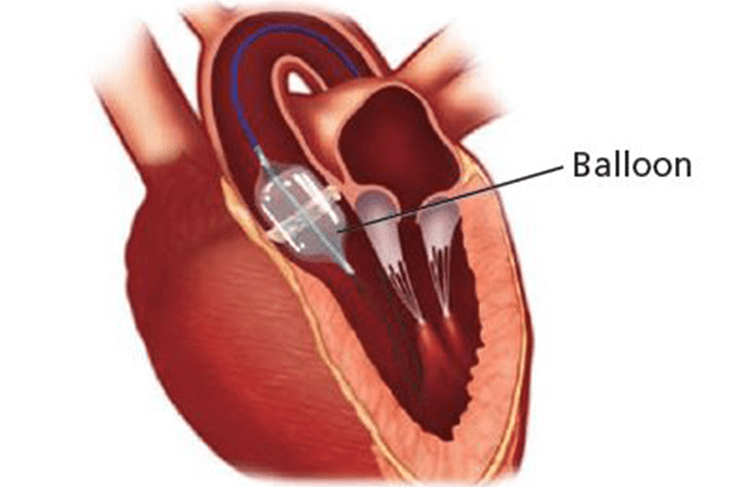 BALLOON VALVULOPLASTIES (BMV/ BPV/BAV)