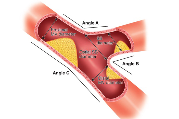 BIFURCATION PCI