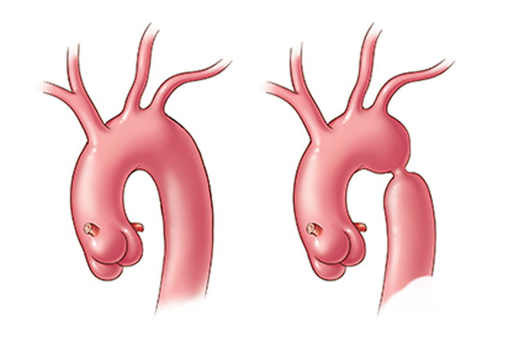 COARCTOPLASTIES FOR CASES OF COARCTATION OF AORTA  by Dr. Nagesh Waghmare, Interventional Cardiologist & Heart Specialist in Mumbai, India.