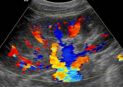 Color Doppler by Dr. Nagesh Waghmare, Interventional Cardiologist & Heart Specialist in Mumbai, India.