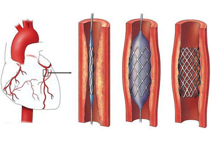 Coronary Angiography by Dr. Nagesh Waghmare, Interventional Cardiologist & Heart Specialist in Mumbai, India.