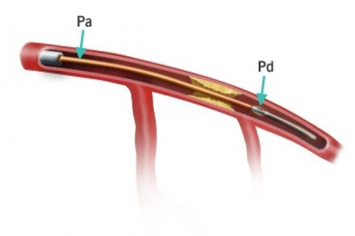 CORONARY PHYSIOLOGY STUDY (FFR) by Dr. Nagesh Waghmare, Interventional Cardiologist & Heart Specialist in Mumbai, India.