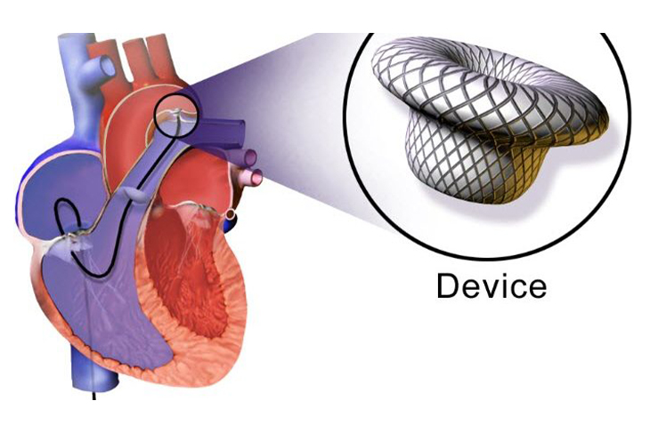 DEVICE CLOSURES FOR HEART HOLES (ASD/ VSD/ PDA)
 by Dr. Nagesh Waghmare, Interventional Cardiologist & Heart Specialist in Mumbai, India.