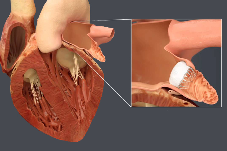 LEFT ATRIAL APPENDAGE CLOSURES WITH DEVICE