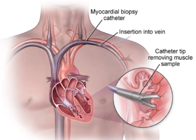 Get the best Myocardial biopsies by Dr. Nagesh Waghmare, Cardiologist with Precise diagnostics for heart conditions, expertly performed.