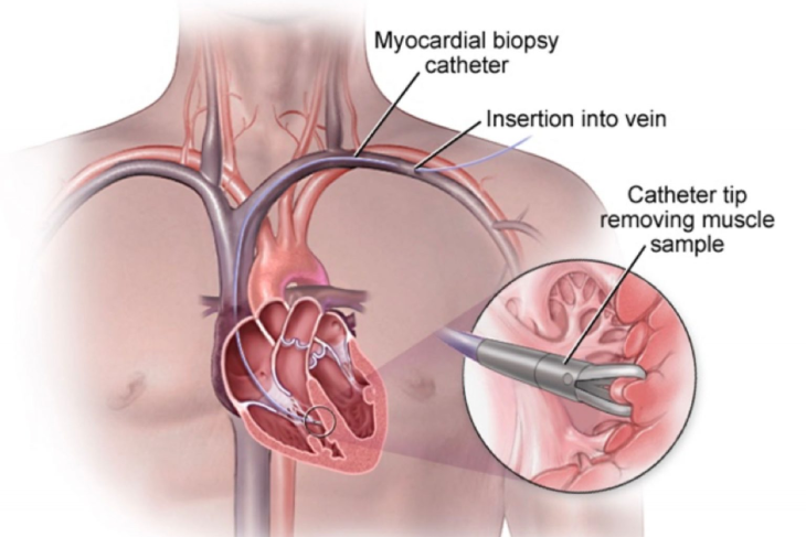 MYOCARDIAL BIOPSIES by Dr. Nagesh Waghmare, Interventional Cardiologist & Heart Specialist in Mumbai, India.