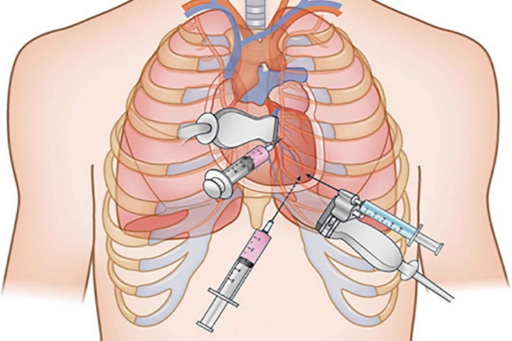 PERICARDIOCENTESIS by Dr. Nagesh Waghmare, Interventional Cardiologist & Heart Specialist in Mumbai, India.