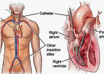 Right Heart Catheterization Study by Dr. Nagesh Waghmare, Interventional Cardiologist & Heart Specialist in Mumbai, India.