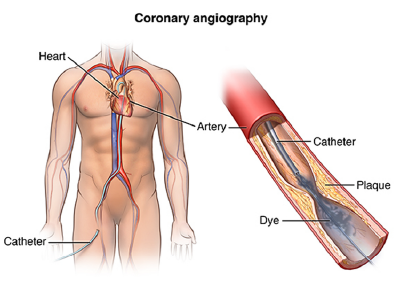 Coronary Angiography by Dr. Nagesh Waghmare, Interventional Cardiologist & Heart Specialist in Mumbai, India.