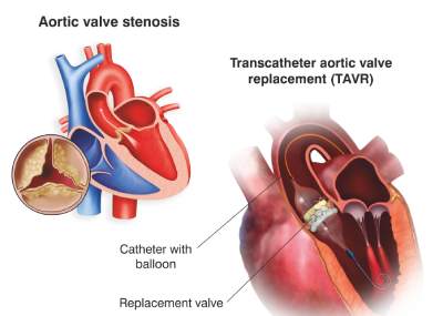 TAVI / TAVR by Dr. Nagesh Waghmare, Interventional Cardiologist & Heart Specialist in Mumbai, India.